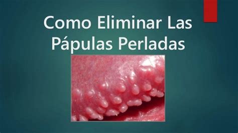 papulas perladas|Pápulas perladas